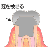 クラウン（被せ物）