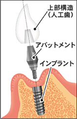 インプラントの構造